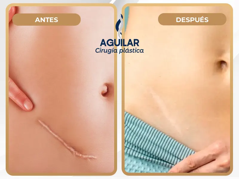Tratamiento médico para la corrección de cicatrices en Lima