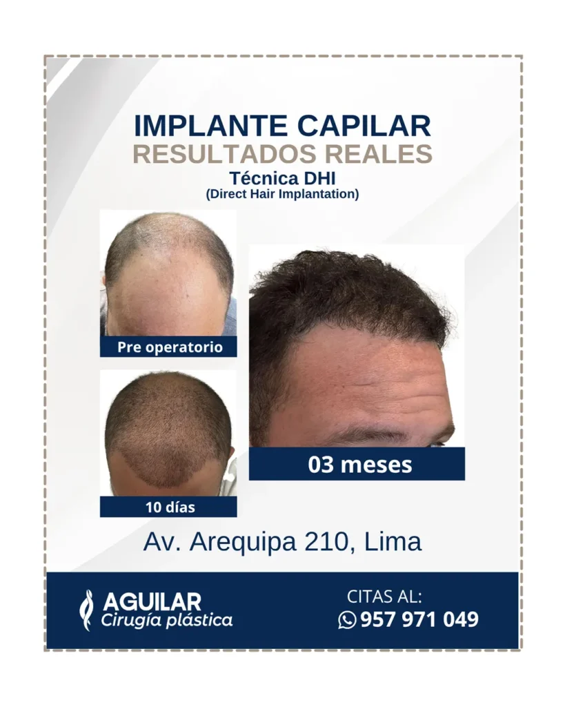 tratamiento capilar en Lima