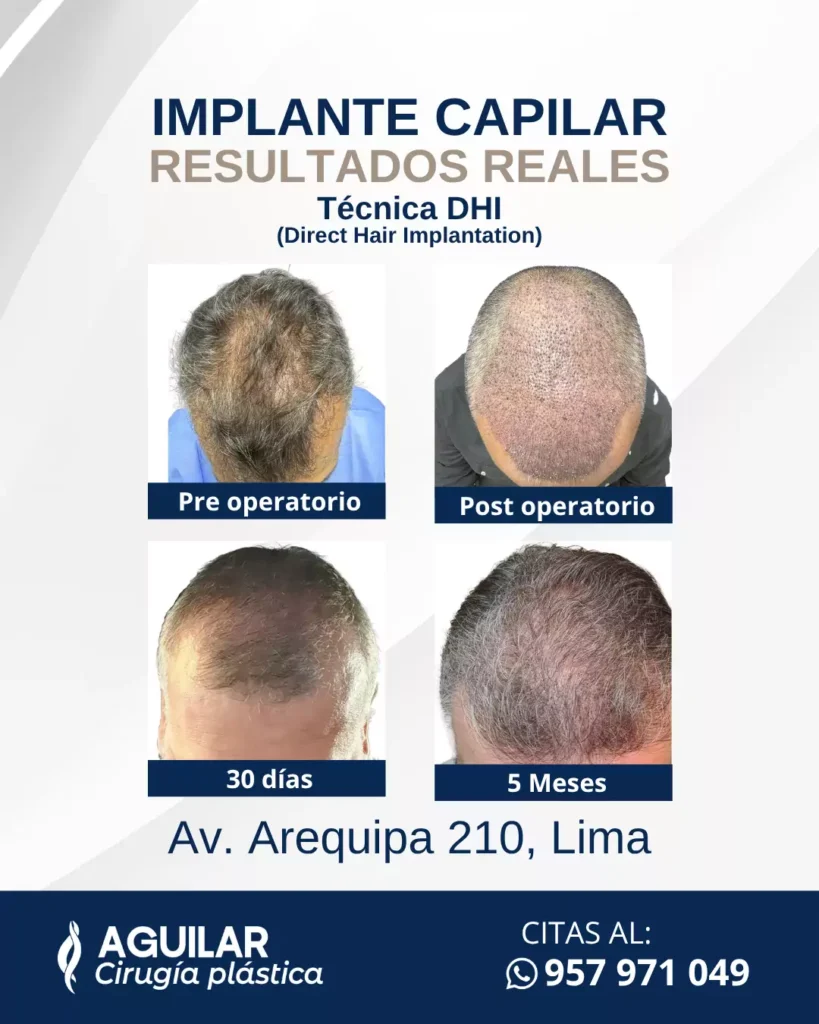 clínica de implante capilar en Lima
