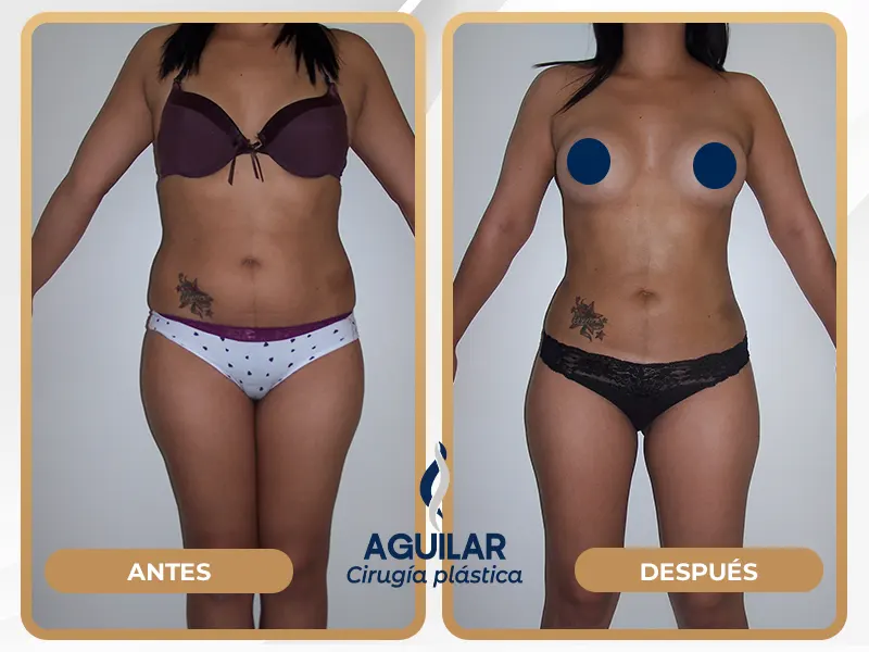 Resultados de lipotransferencia en glúteos antes y después