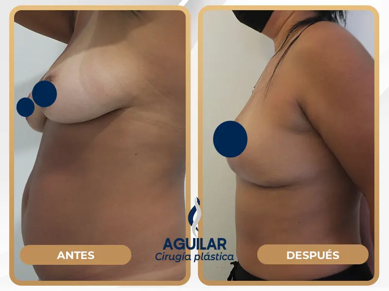 Aumento de volumen con grasa propia resultados naturales