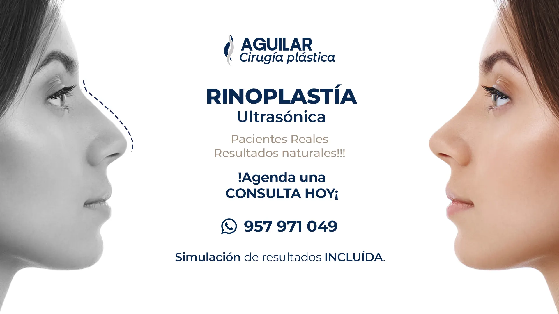 rinoplastia ultrasónica antes y después Lima Perú